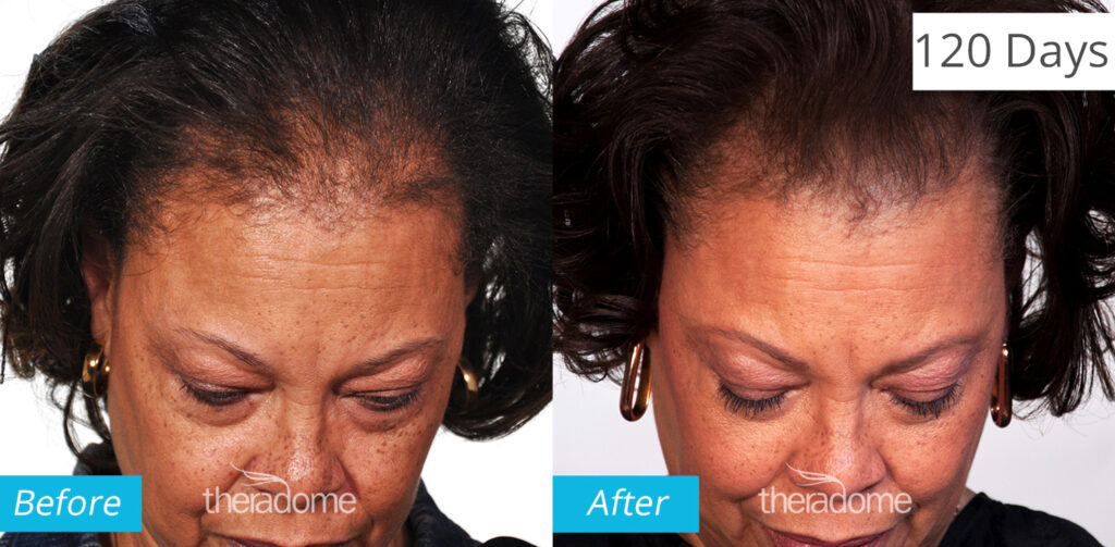 Non Surgical Treatments before and after photo by Elite Dermatology & The Oaks Plastic Surgery in Houston TX