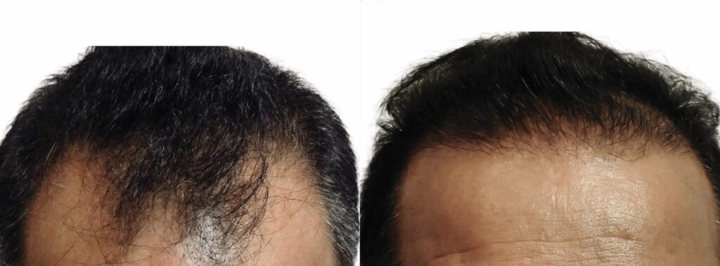 Hair Transplant before and after photo by Elite Dermatology & The Oaks Plastic Surgery in Houston TX