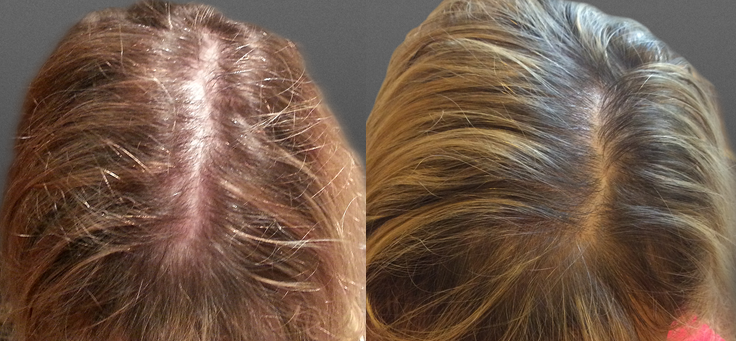 Non Surgical Treatments before and after photo by Elite Dermatology & The Oaks Plastic Surgery in Houston TX