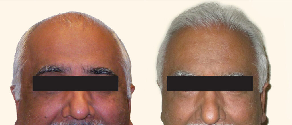 Hair Transplant before and after photo by Elite Dermatology & The Oaks Plastic Surgery in Houston TX