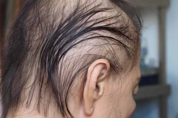 Anagen effluvium. Side view of an old Asian woman having hair fall problems during her chemotherapy course