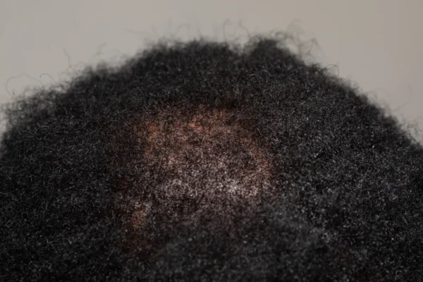 CCCA Crown Hair loss on afro american head scalp