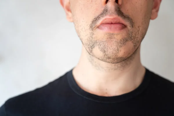 Close up of alopecia areata on a mans beard