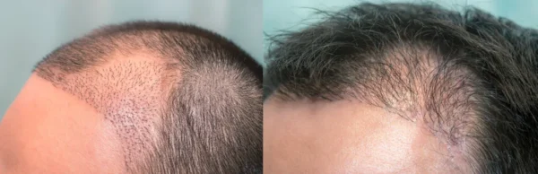 Close up top view of a mans head with hair transplant surgery with a receding hair line. months after Bald head of hair loss treatment.