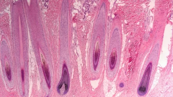 Photomicrograph of cross section human scalp showing histology of hair follicles.