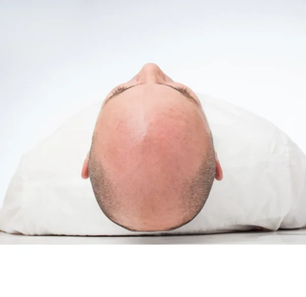 bald man with advanced hair loss