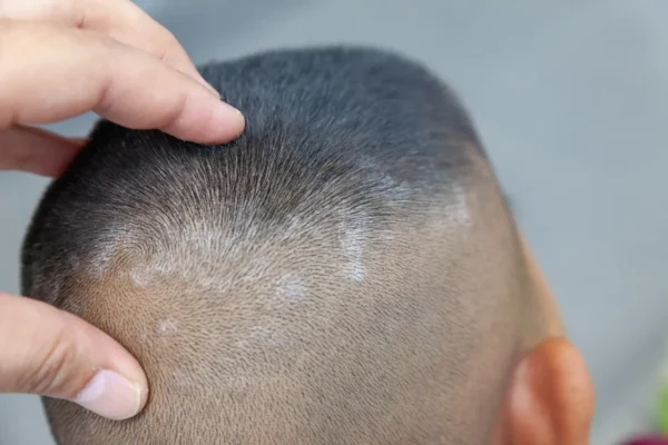 boy with grey patches Close up skin head scalp photos of dermatitis and eczema skin problems dermatology