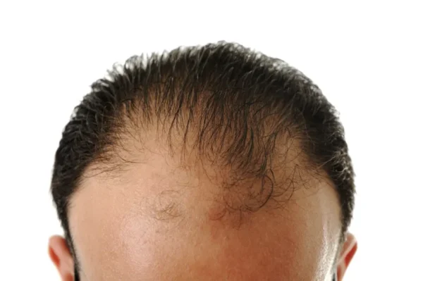frontal balding