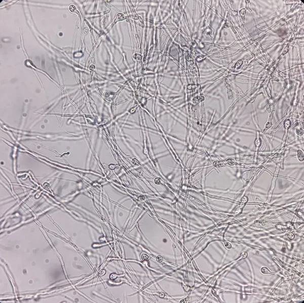 koh scraping. Photomicrograph showing Hyphae of dermatophytes Nail scraping or skin scraping for fungus test in microbiology laboratory.