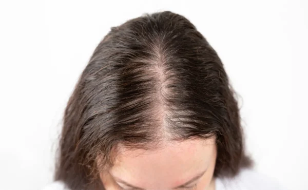 midline part hair loss female
