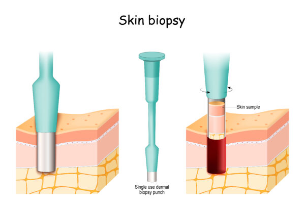 Skin Biopsy. Punch biopsy take skin sample
